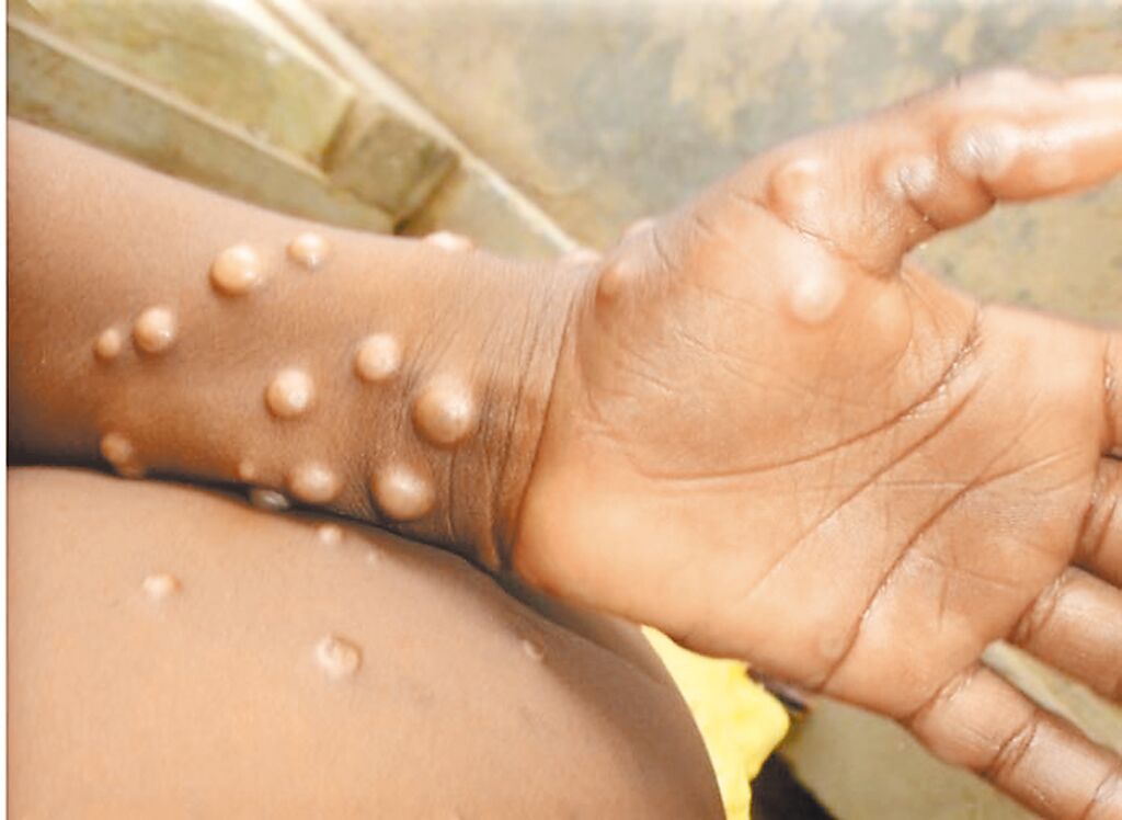 菲律賓再有2男感染M痘 2024年確診病例增至3人