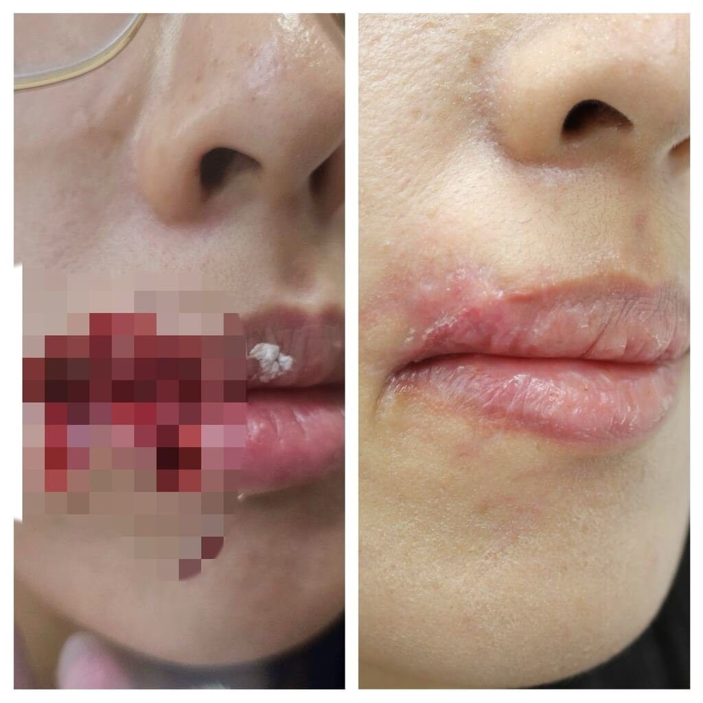 女遭愛犬咬掉嘴邊肉 醫採PRP增生療法免毀容 女遭愛犬咬掉嘴邊肉 醫採PRP增生療法免毀容